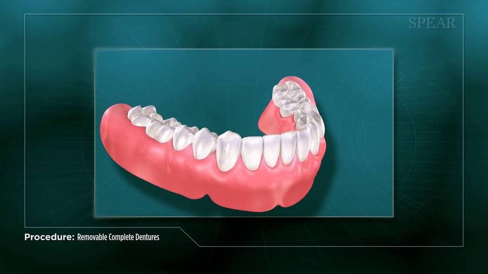 Digital Dentures Napoleon ND 58561